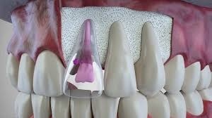 Dental Internal Resorption