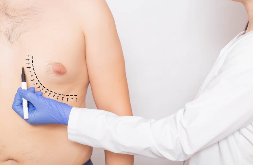 Dose Gynecomastia Surgery Affect Exercise Routine