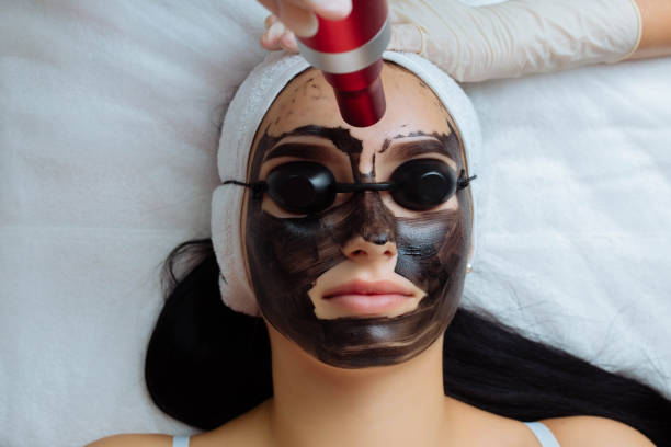 Dose a Laser Carbon Peel Reduce Acne Effectively?