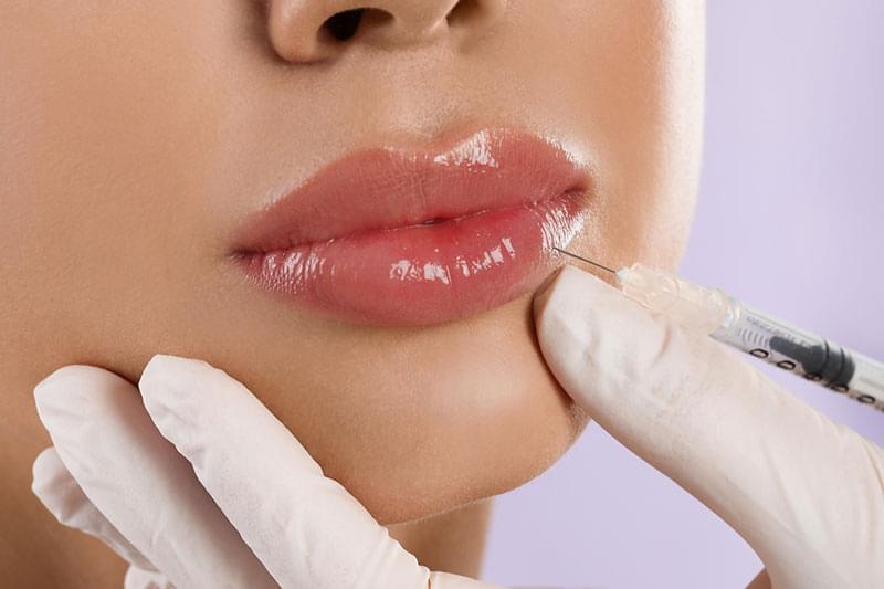 Enhance Lip Contours with Perfectha Fillers