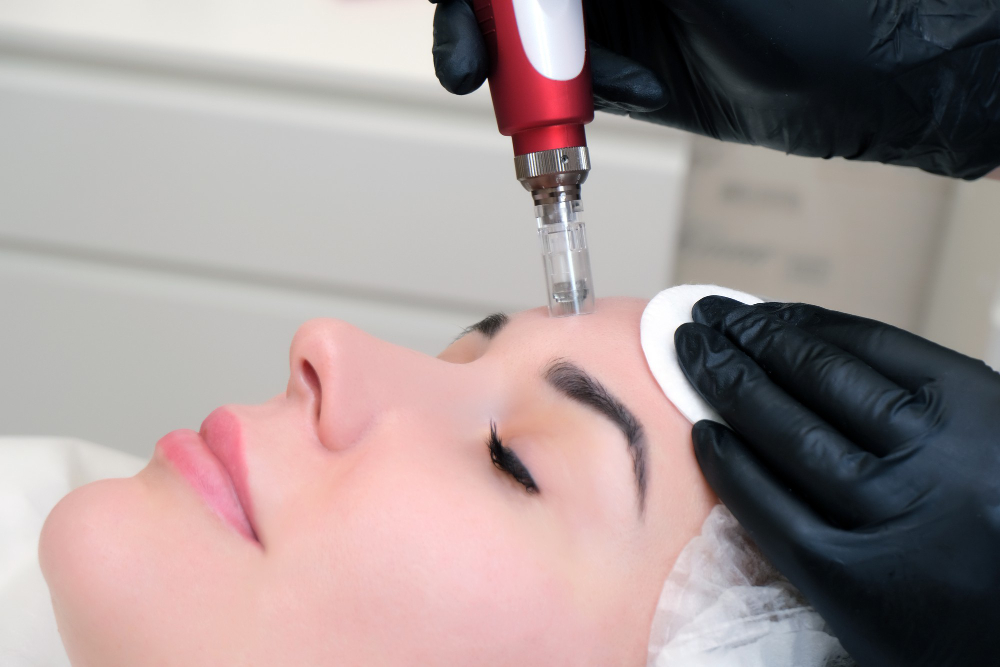How Long Does Microneedling for Acne Scars Take to Heal