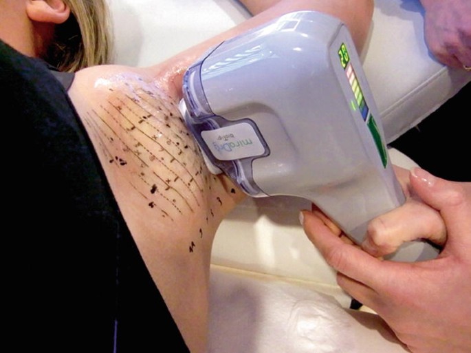 Long Lasting Relief from Hyperhidrosis