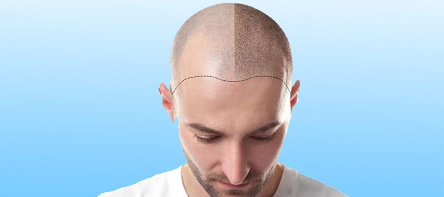 Restore Hair Volume with FUE Hair Transplant