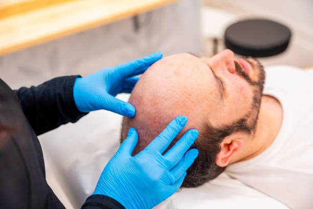 What Results Can I Expect From Crown Hair Transplant