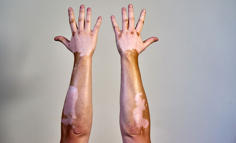 What Results Can Vitiligo Treatment Delive