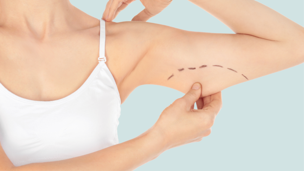 What Results Can You Expect From an Arm Lift?