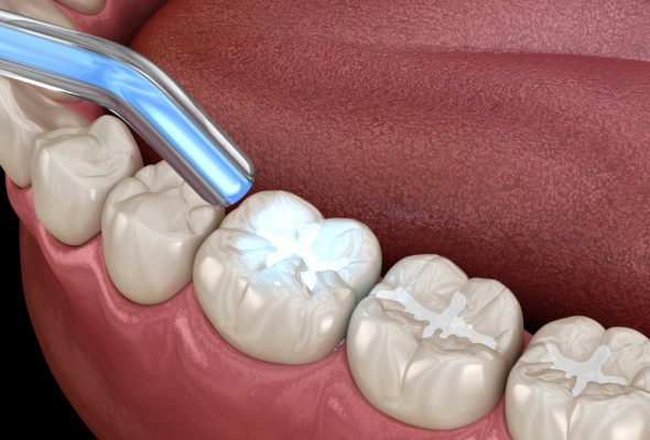 Dental Tooth Filling for Minor Tooth Damage