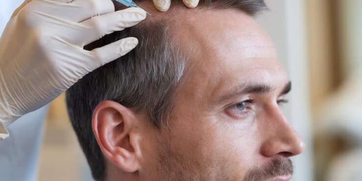 Preparing Mentally for the Best PRP Hair Treatment Journey
