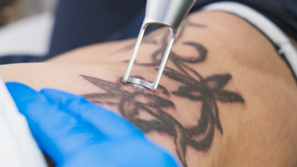 Clear Skin Starts Here with Laser Tattoo Removal in Abu Dhabi