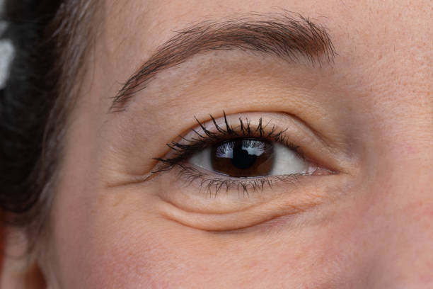 Are Under Eye Fillers the Best Fix for Tired Eyes?