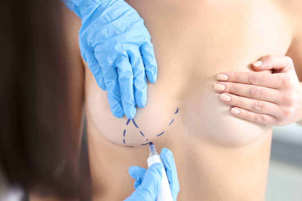 Breast Lift for Elegant, Lasting Results