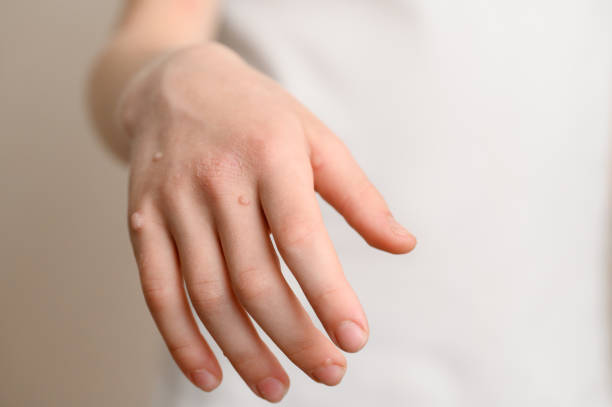 Can Sensitive Skin Get Warts Removal Treatment