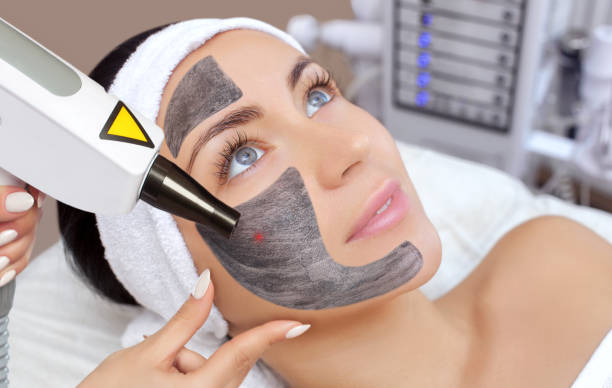 Does Laser Carbon Peel Help Acne Scars