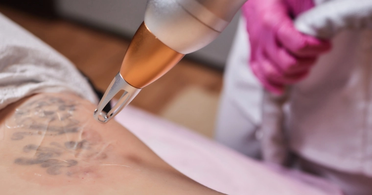 How Long Does Picosure Tattoo Removal Take to Heal