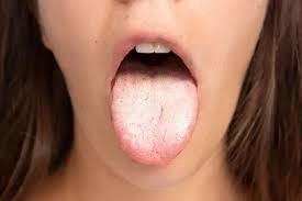 How to Heal Burnt Tongue