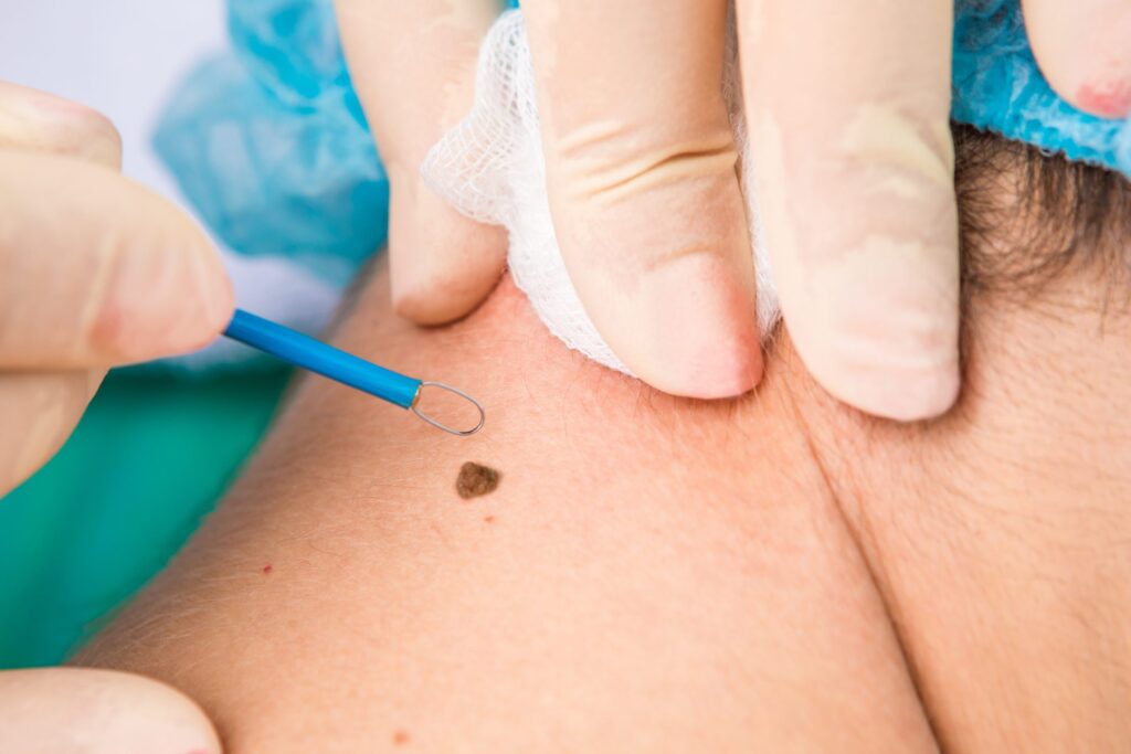 How to Know If Mole Removal Is Necessary