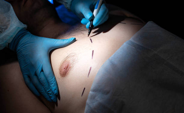 Is Gynecomastia Surgery the Best Way to Remove Fat