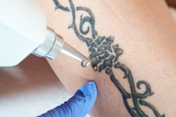 Laser Tattoo Removal in Riyadh