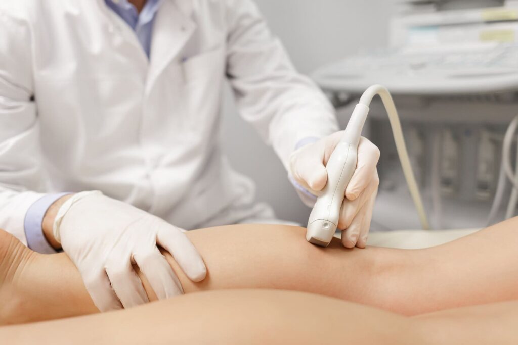 What Can You Expect After a Sclerotherapy Session