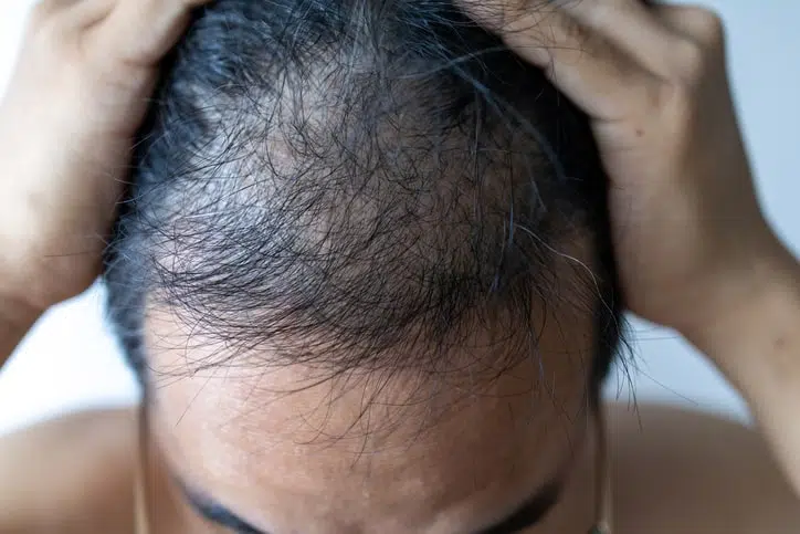What Causes Hair Loss and Treatment