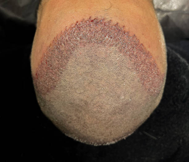 What Makes FUE Hair Transplant Popular Worldwide