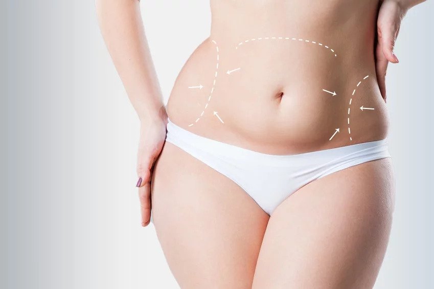 What Makes Lipo Abdominoplasty Different from Tummy Tuck