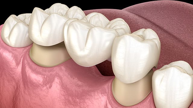 How Strong Are Dental Crowns and Bridges?