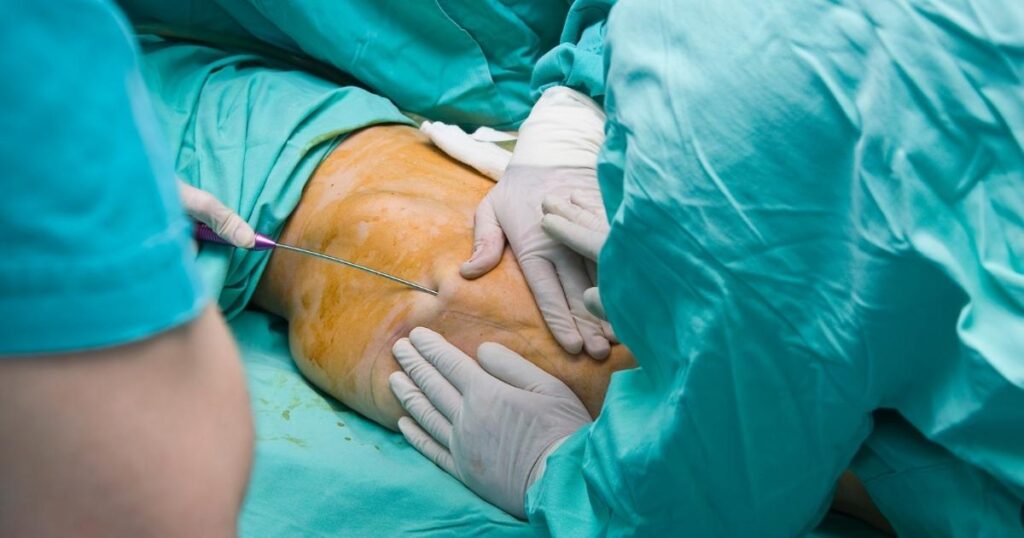 Ultrasound-Assisted Liposuction: Explained