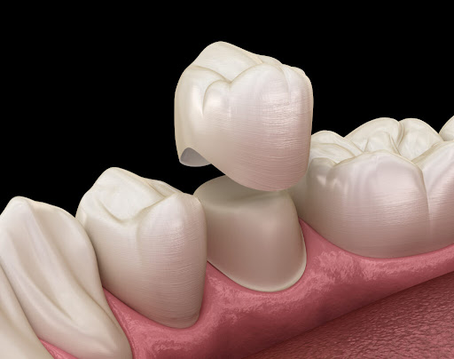 Dental Crowns and Bridges for Bite and Jaw Alignment
