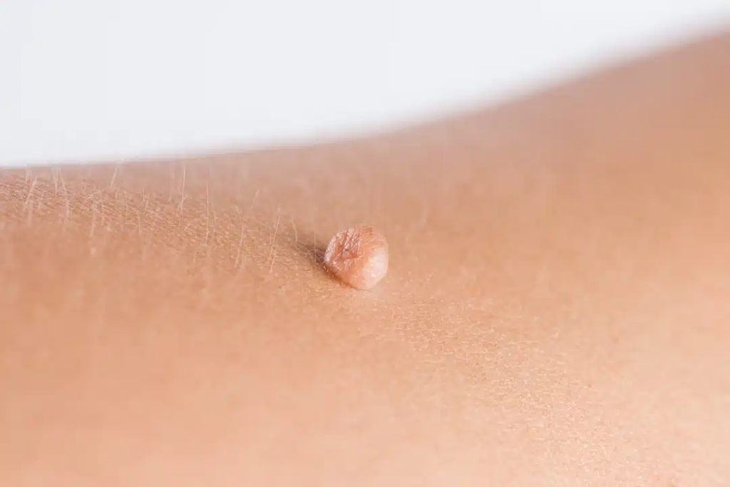Skin Wart Removal Cost for Multiple Treatment Sessions