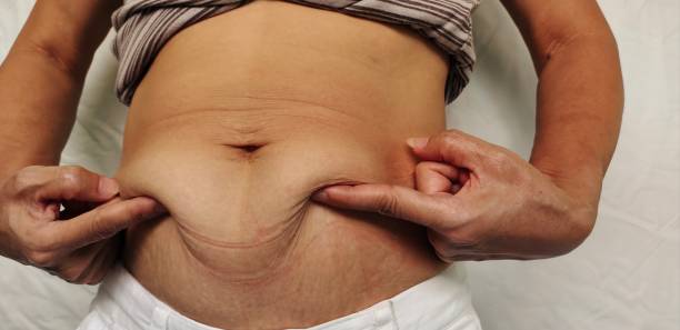 Does Tummy Tuck Surgery Remove Stretch Marks?