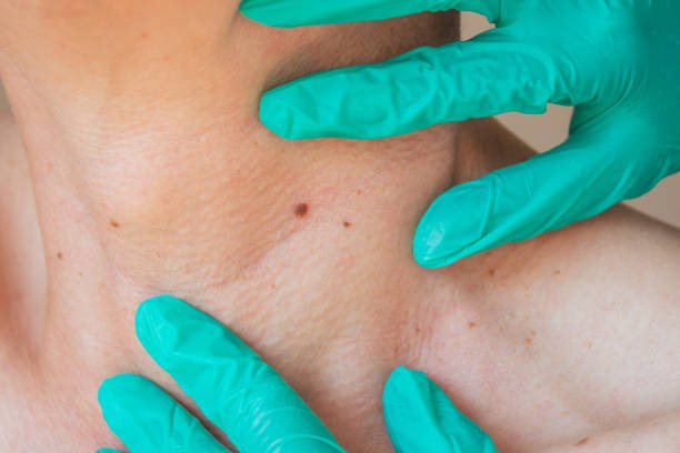 Can Mole Removal Help Improve Skin Texture
