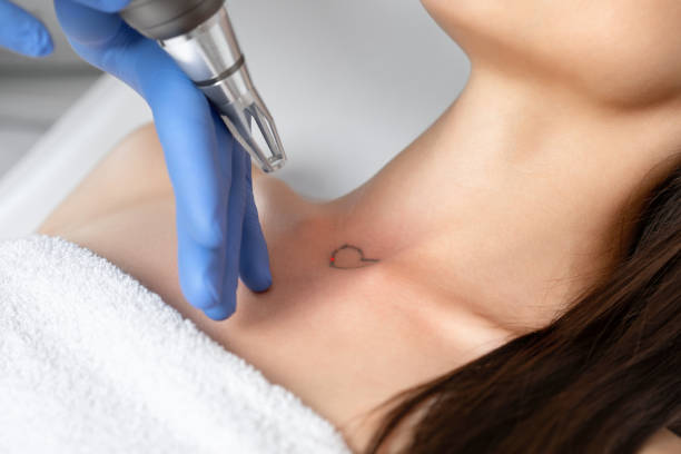 Can Tattoo Removal Be Done on All Body Parts Safely