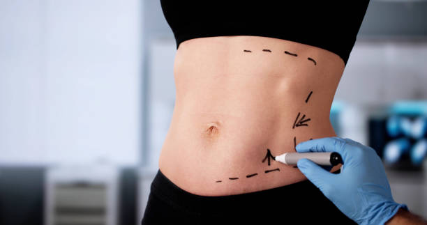 Does Lipo Abdominoplasty Remove Stretch Marks