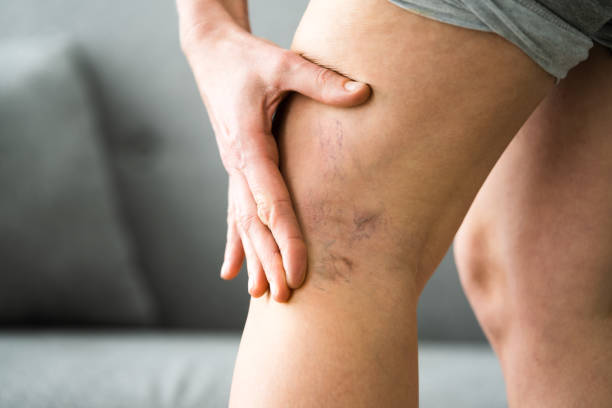 Does Sclerotherapy Prevent Veins from Returning