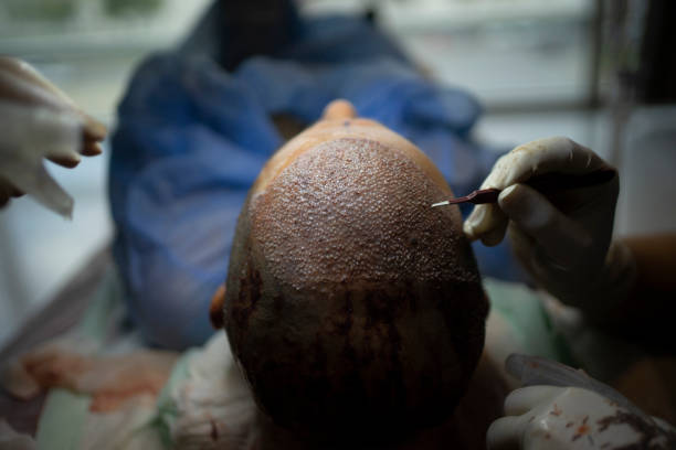 How Hair Transplant Minimizes Visible Scars