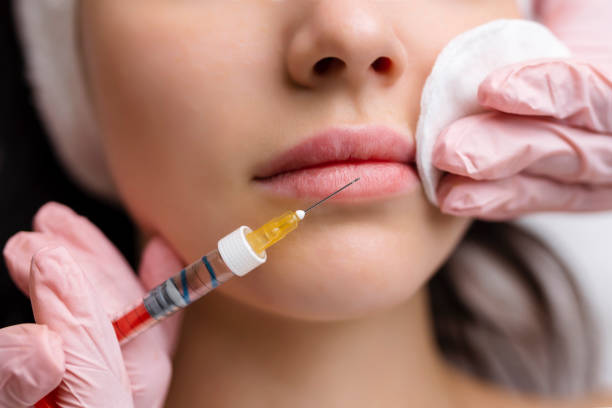 How Often Should You Repeat Lip Fillers Injection