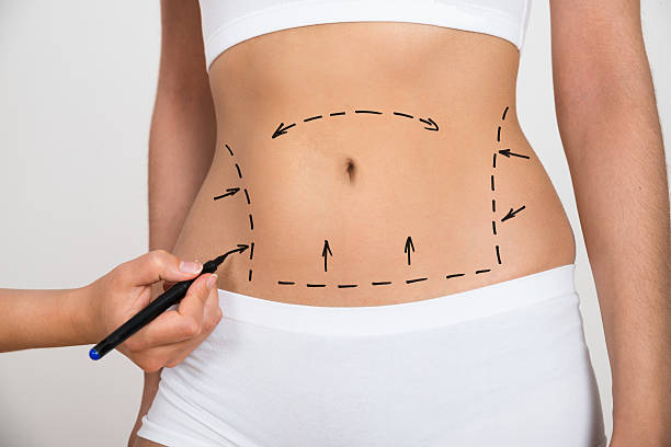 How Painful Is Liposuction Compared to Surgery