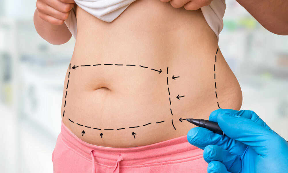 Refine Your Body Shape with Mini Abdominoplasty
