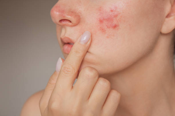 What Acne Treatment Options Are Safe During Pregnancy