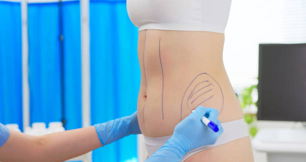 What’s the Success Rate of Waist Sculpting Surgery?