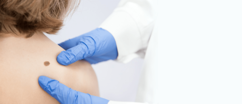 Mole Removal in Abu Dhabi