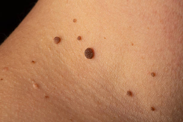 Does Warts Removal Help Restore Smooth Skin Faster