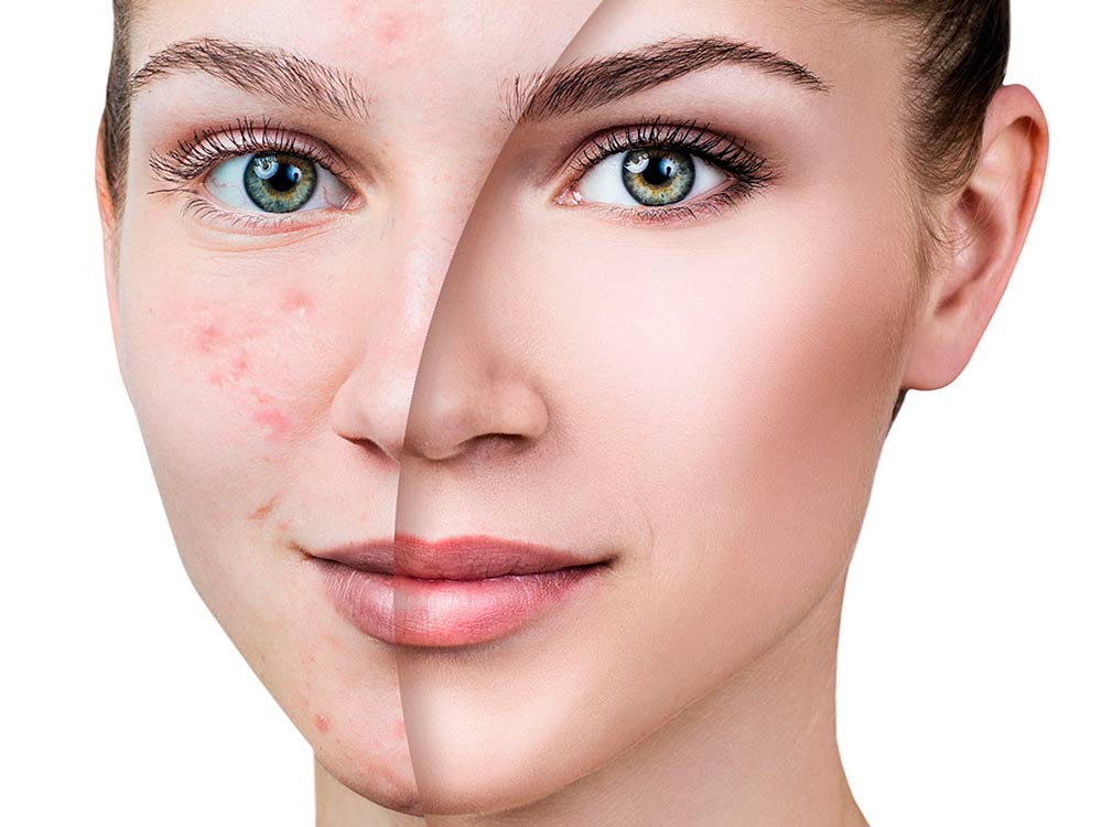 Acne Treatment in Abu Dhabi