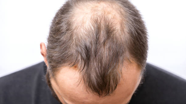 How Does Hair Loss Treatment Restore Healthier Hair