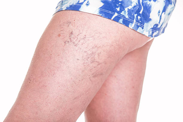 How Does Spider Vein Treatment Help Boost Confidence
