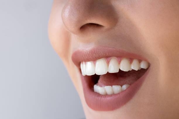 How Does Teeth Whitening Help Remove Deep Stains Fast