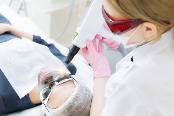 How Laser Carbon Peel Reduces Excess Oil Shine