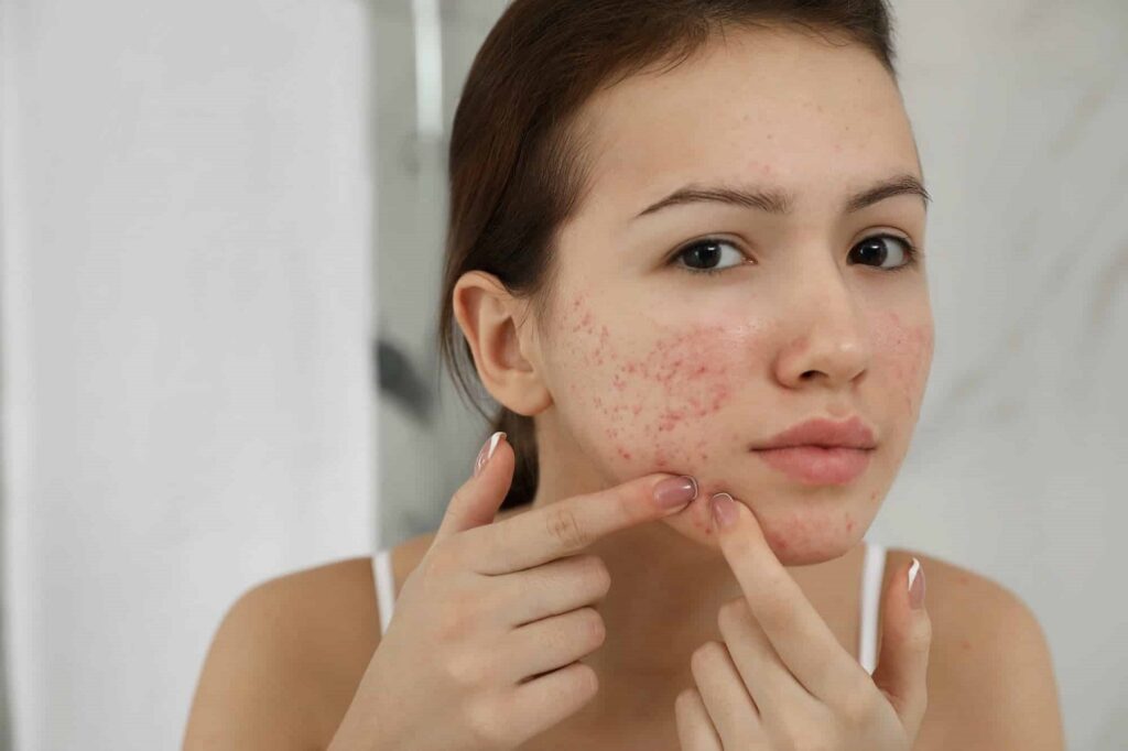 Laser Acne Scar treatment in Abu Dhabi