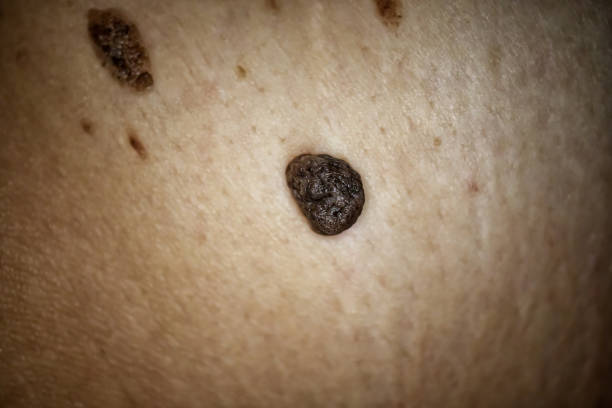 Is Mole Removal Safe for Darker or Sensitive Skin